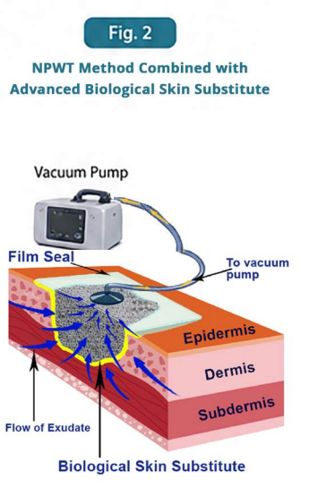 NPWT Combined with an Advanced biological skin substitute
